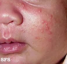 Common topical steroids for eczema